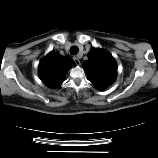 Cavitating pulmonary metastases (Radiopaedia 89545-106544 Axial non-contrast 7).jpg