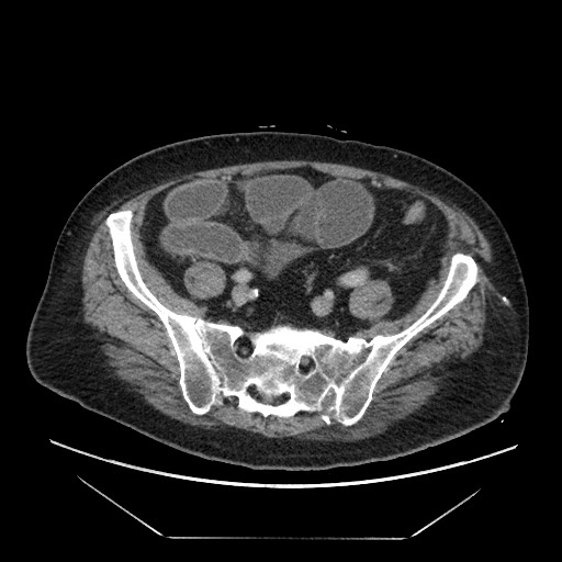 Cecal adenocarcinoma (Radiopaedia 64871-73817 A 72).jpg