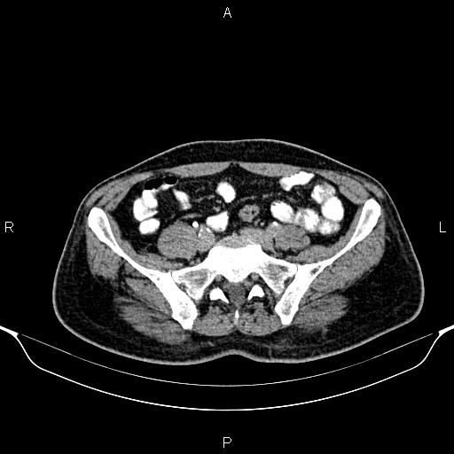 Cecal adenocarcinoma (Radiopaedia 85324-100916 Axial C+ delayed 71).jpg