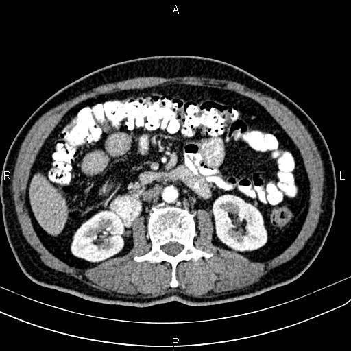 File:Cecal cancer with appendiceal mucocele (Radiopaedia 91080-108651 A 85).jpg