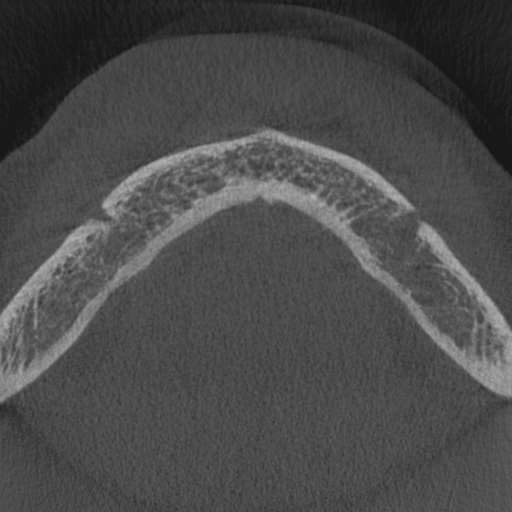 Cemento-osseous dysplasia (Radiopaedia 48251-53126 Axial non-contrast 6).jpg