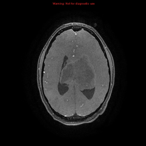 Central neurocytoma (Radiopaedia 13188-13206 Axial MRA 5).jpg