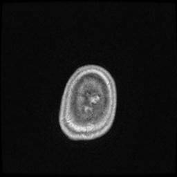 Central neurocytoma (Radiopaedia 30220-30842 Axial T1 C+ 147).jpg