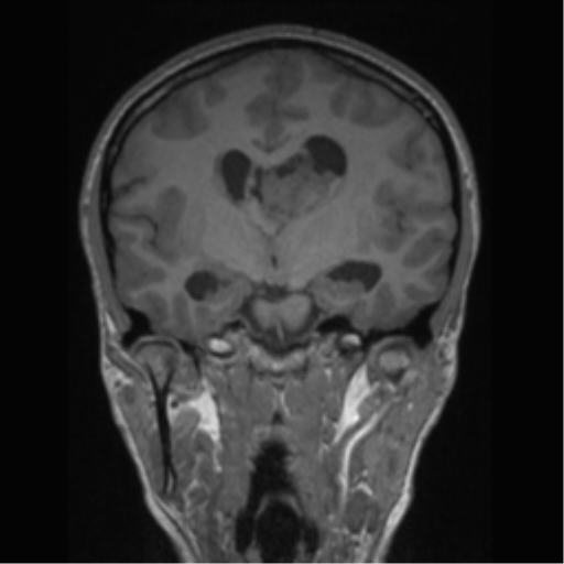 Central neurocytoma (Radiopaedia 37664-39557 Coronal T1 47).png