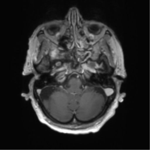 Central neurocytoma (Radiopaedia 65317-74345 Axial T1 C+ 6).png