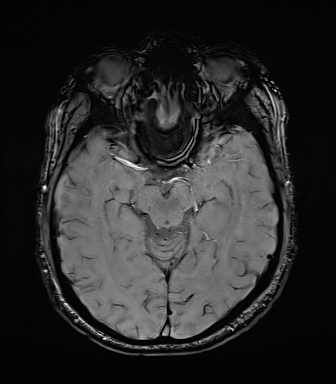 Central neurocytoma (Radiopaedia 71068-81303 Axial SWI 23).jpg