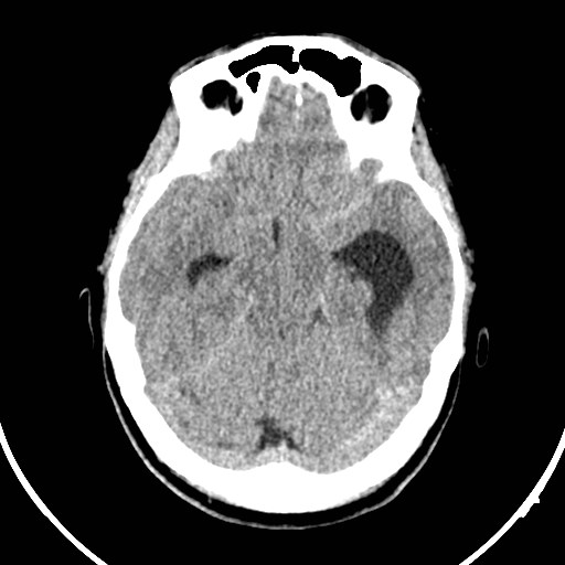 Central neurocytoma (Radiopaedia 84497-99871 Axial non-contrast 16).jpg