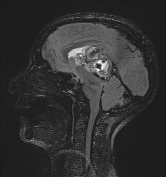 File:Central neurocytoma (Radiopaedia 84497-99872 Sagittal Flair + Gd 80).jpg
