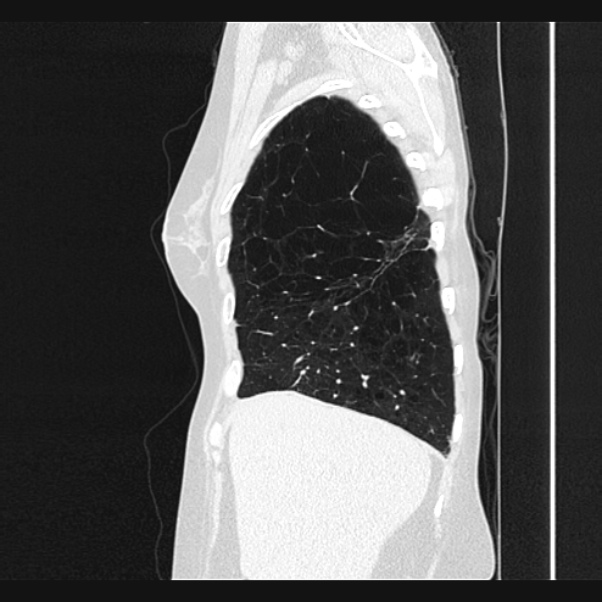 Centrilobular pulmonary emphysema (Radiopaedia 24495-24789 Sagittal lung window 14).jpg