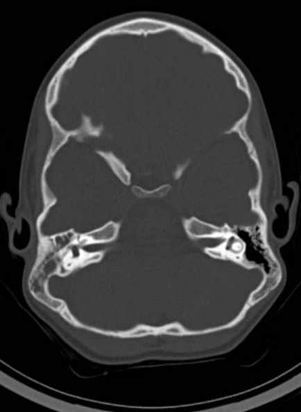 File:Cerebellar abscess (Radiopaedia 73727-84527 Axial bone window 26).jpg