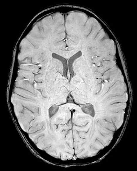 Cerebellar abscess (Radiopaedia 73727-84563 Axial SWI 40).jpg