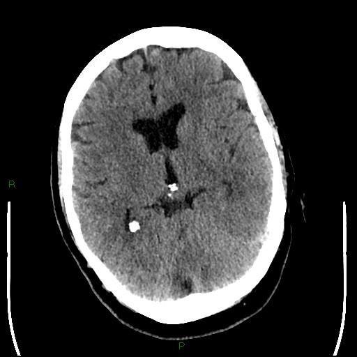 Cerebellar abscess (Radiopaedia 78135-90671 Axial non-contrast 54).jpg