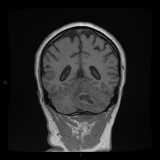 File:Cerebellar abscess (Radiopaedia 78135-90678 Coronal T1 C+ 117).jpg