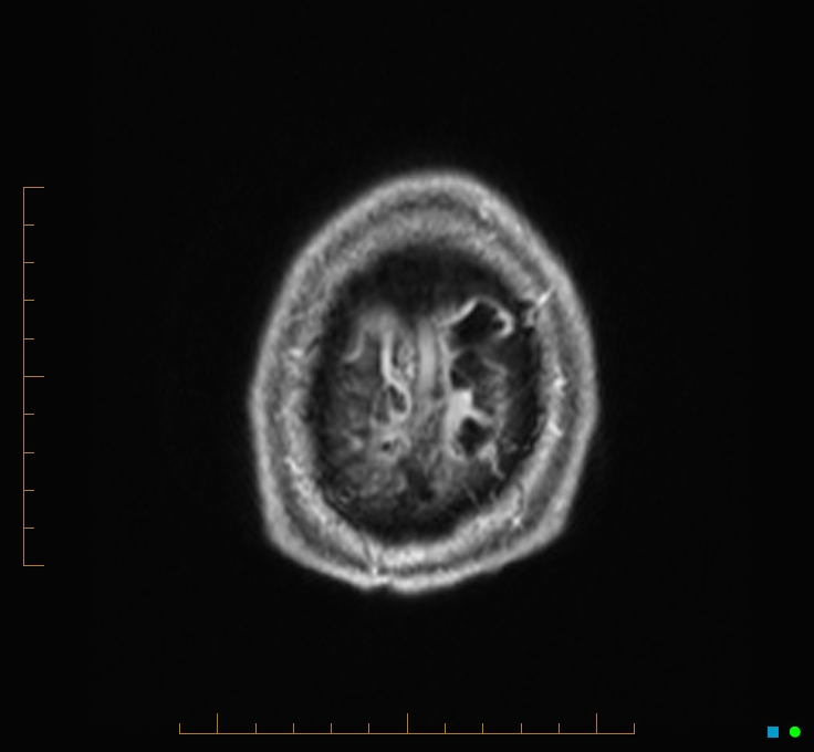 Cerebellar gangliocytoma (Radiopaedia 65377-74422 Axial T1 C+ 140).jpg