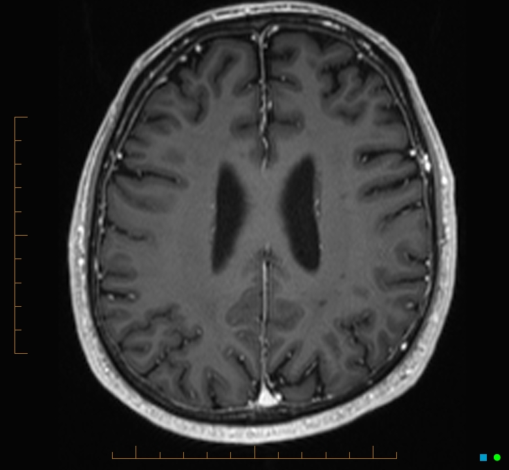 Cerebellar gangliocytoma (Radiopaedia 65377-74422 Axial T1 C+ 91).jpg