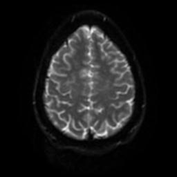 Cerebellar hemangioblastoma (Radiopaedia 29570-30077 Axial DWI 47).jpg