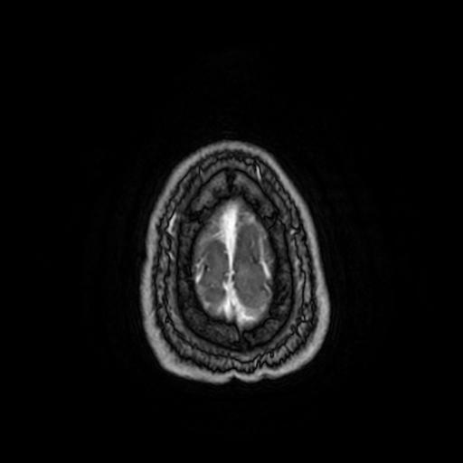 Cerebellar hemangioblastoma (Radiopaedia 88055-104622 Axial T1 C+ 162).jpg