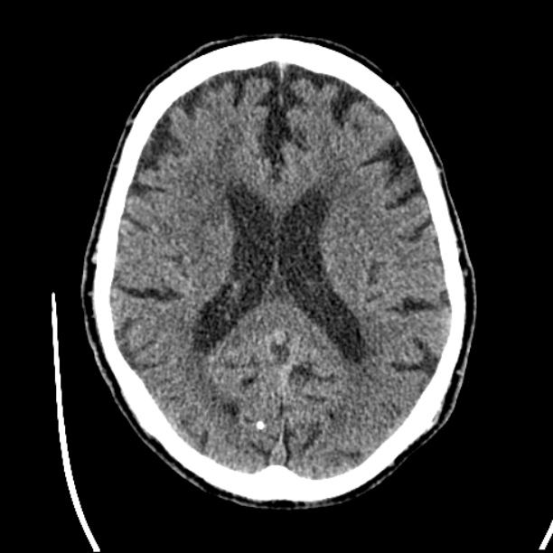 Cerebellar hemorrhage (Radiopaedia 27193-27359 Axial non-contrast 30).jpg