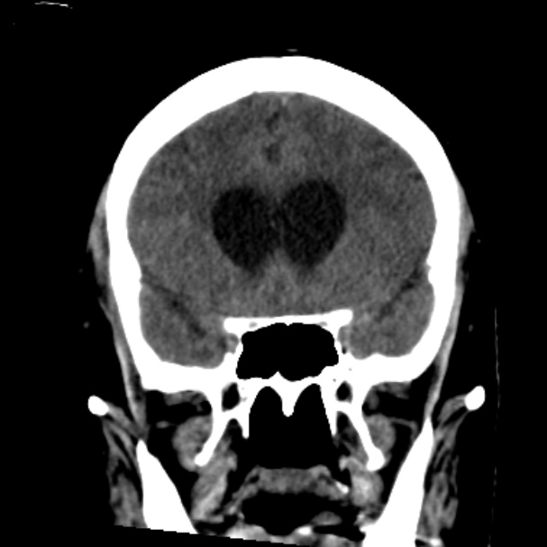 Cerebellar hemorrhage causing obstructive hydrocephalus (Radiopaedia 33989-35207 Coronal non-contrast 20).jpg