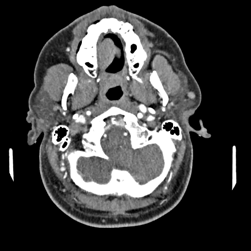 Cerebellar infarct due to vertebral artery dissection with posterior fossa decompression (Radiopaedia 82779-97029 C 47).png