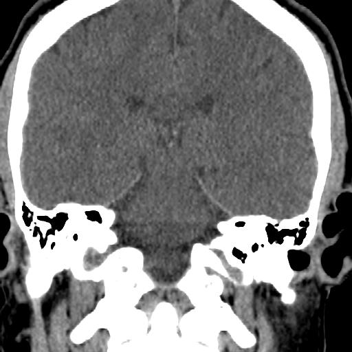 Cerebellar infarction (Radiopaedia 16625-16327 Coronal non-contrast 16).jpg