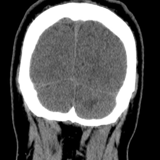 Cerebellar infarction (Radiopaedia 16625-16327 Coronal non-contrast 40).jpg