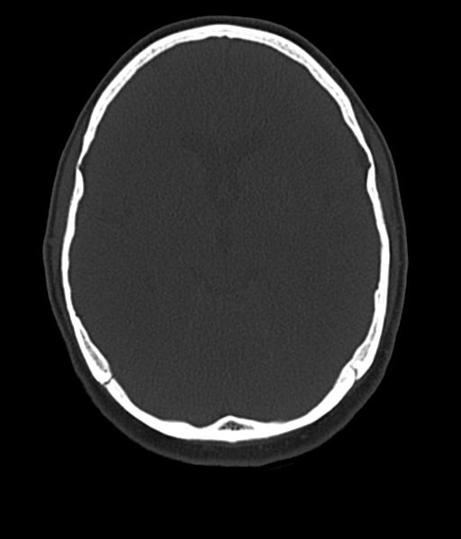 File:Cerebellar metastases - colorectal adenocarcinoma (Radiopaedia 40947-43652 AX Bone C- 2.0 MPR 28).png