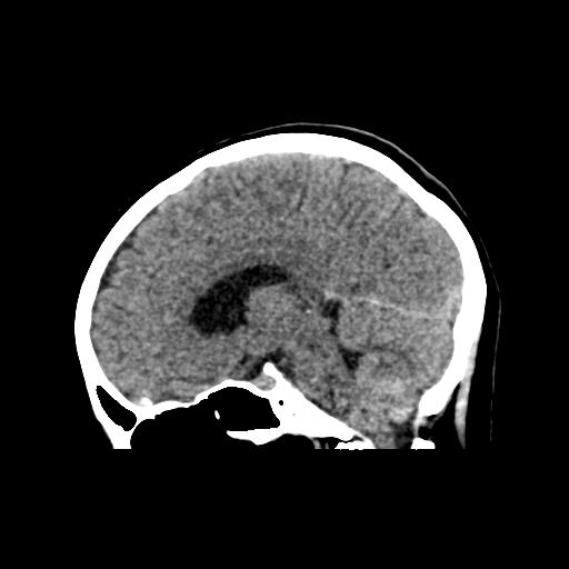 Cerebellar metastases - colorectal adenocarcinoma (Radiopaedia 40947-43652 Axial non-contrast 1).png