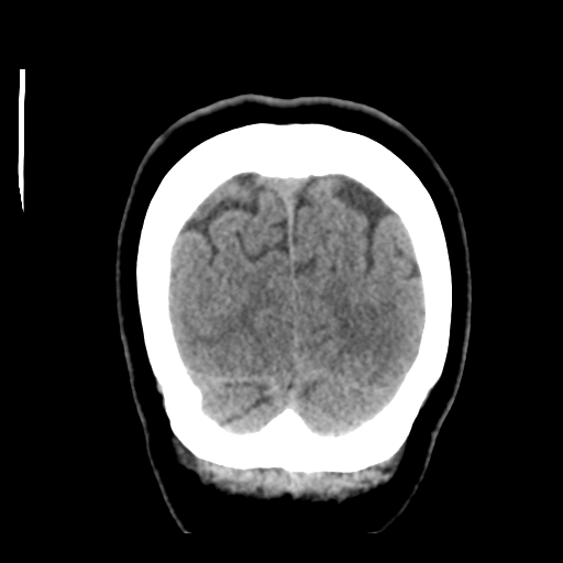 Cerebellar metastasis (cystic appearance) (Radiopaedia 41395-44258 Coronal non-contrast 54).png