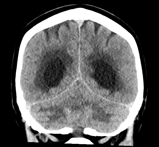 File:Cerebellar metastasis from lung adenocarcinoma (Radiopaedia 86690-102828 Coronal non-contrast 29).png