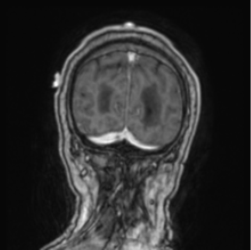 Cerebellar metastasis from lung adenocarcinoma (Radiopaedia 86690-102829 Coronal T1 C+ 13).png