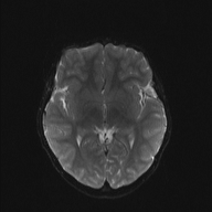File:Cerebellar stroke (Radiopaedia 32202-33150 Axial DWI 12).png