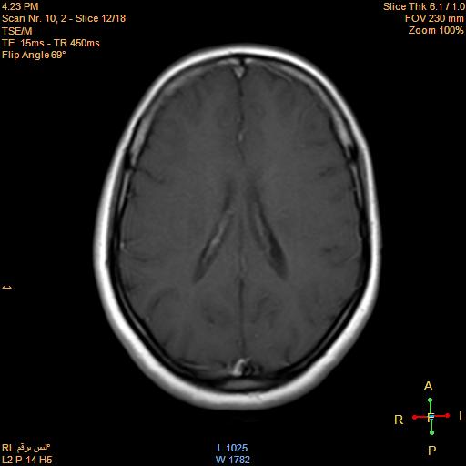 File:Cerebellopontine angle meningioma (Radiopaedia 22488-22525 Axial T1 C+ 11).jpg