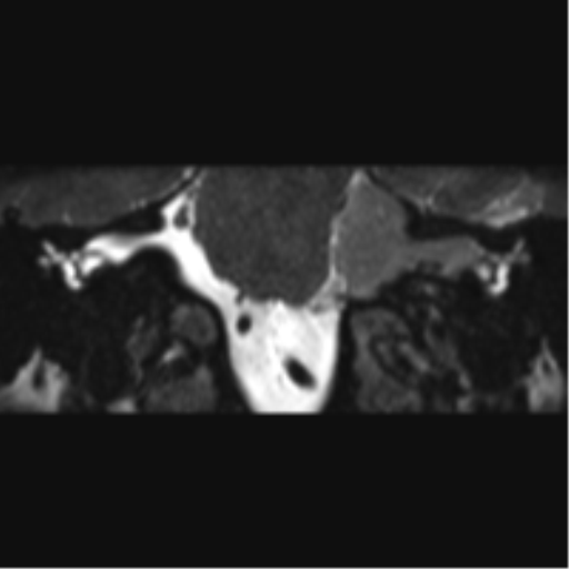 Cerebellopontine angle meningioma (Radiopaedia 48434-53348 Coronal T2 50).png