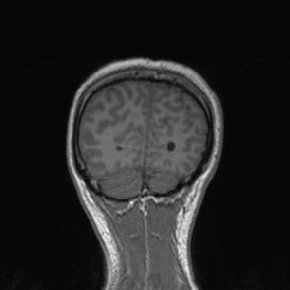Cerebral abscess (Radiopaedia 24212-24478 Coronal T1 170).jpg