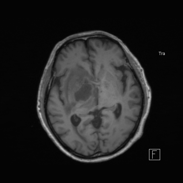 Cerebral abscess (Radiopaedia 26111-26247 Axial T1 32).jpg