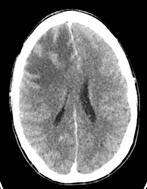 Cerebral abscess (Radiopaedia 60342-68008 Axial C+ delayed 32).png