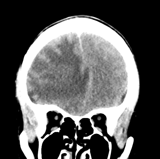 File:Cerebral abscess (Radiopaedia 60342-68008 Coronal non-contrast 17).png