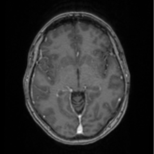Cerebral abscess from pulmonary arteriovenous malformation (Radiopaedia 86275-102291 Axial T1 C+ 36).png