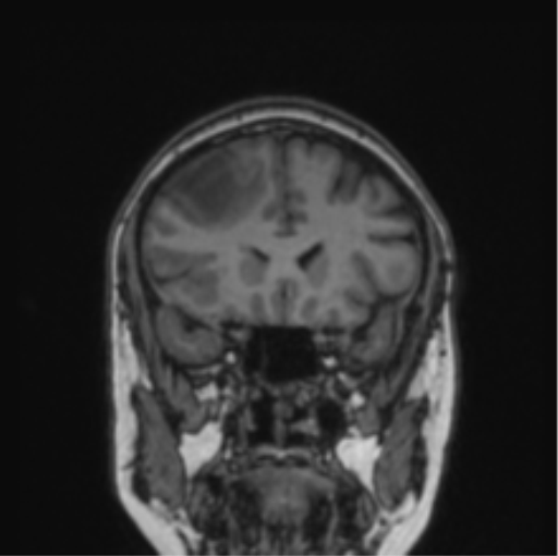 Cerebral abscess from pulmonary arteriovenous malformation (Radiopaedia 86275-102291 Coronal T1 63).png