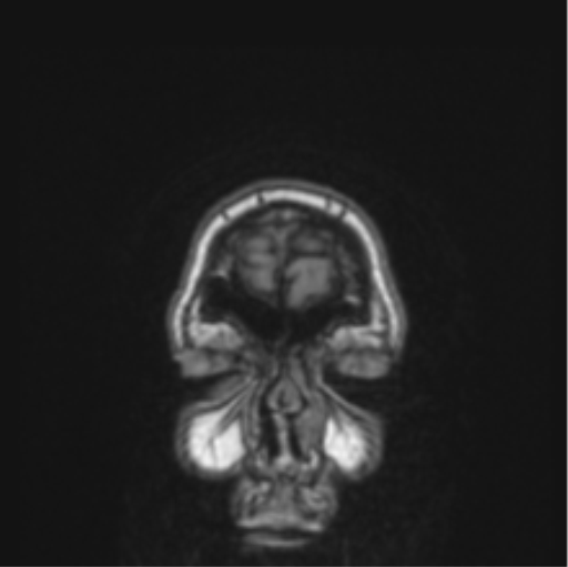 File:Cerebral abscess from pulmonary arteriovenous malformation (Radiopaedia 86275-102291 Coronal T1 85).png