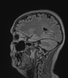 Cerebral abscess from pulmonary arteriovenous malformation (Radiopaedia 86275-102291 Sagittal FLAIR 27).png