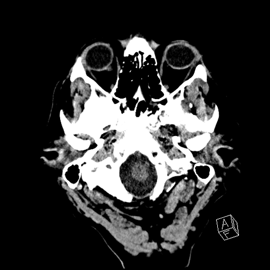 Cerebral abscess with ventriculitis (Radiopaedia 78965-91876 Axial non-contrast 8).jpg