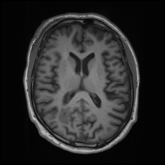 File:Cerebral abscess with ventriculitis (Radiopaedia 78965-91878 Axial T1 28).jpg