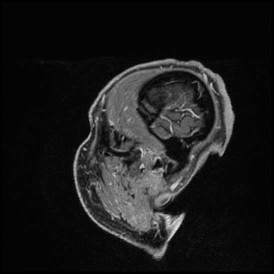 Cerebral abscess with ventriculitis (Radiopaedia 78965-91878 Sagittal T1 C+ 165).jpg