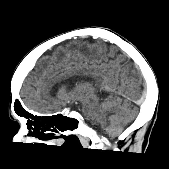 Cerebral amyloid angiopathy-related inflammation (Radiopaedia 74836-85848 C 34).jpg