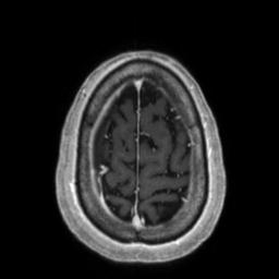 Cerebral amyloid angiopathy (Radiopaedia 29129-29518 Axial T1 C+ 131).jpg