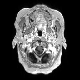 Cerebral amyloid angiopathy (Radiopaedia 29129-29518 Axial T1 C+ 17).jpg