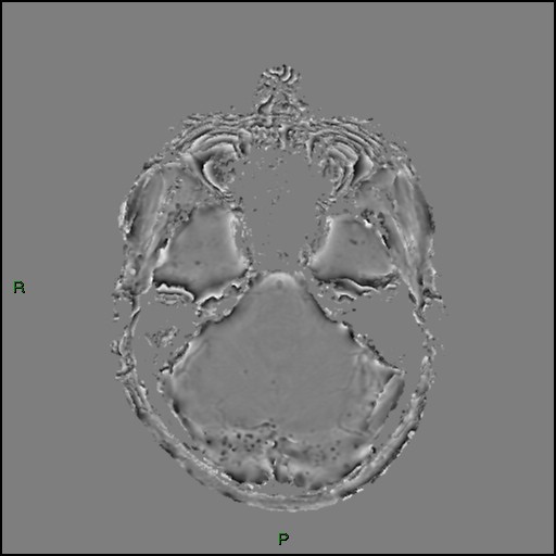 File:Cerebral amyloid angiopathy (Radiopaedia 77506-89664 H 32).jpg