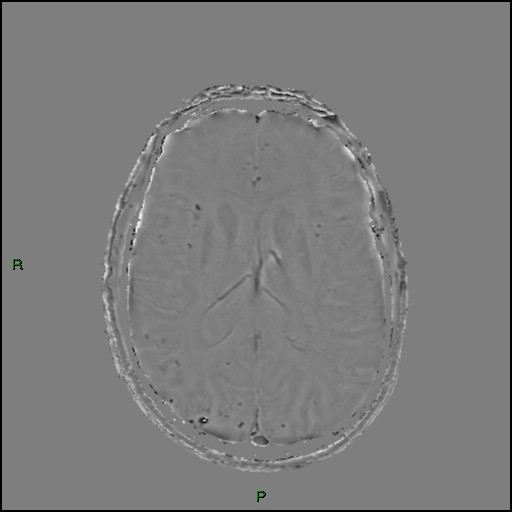 Cerebral amyloid angiopathy (Radiopaedia 77506-89664 H 60).jpg